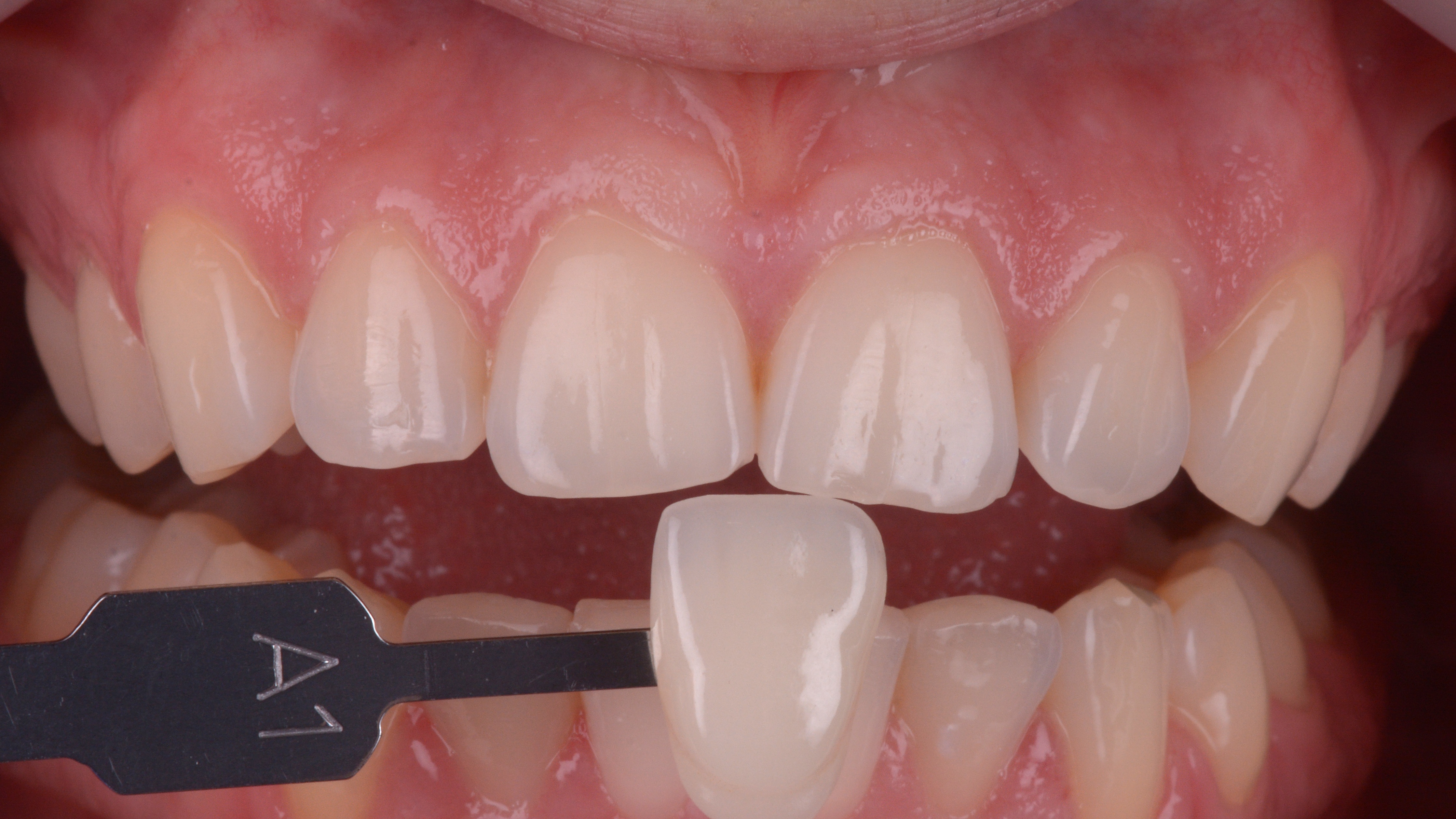 White Dental Beauty Case Minimum Sensitivity After External Bleaching
